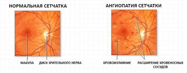 ангиопатия сетчатка и здоровый глаз